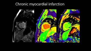 9. CMR Parametric Mapping Dr  Richa Kothari