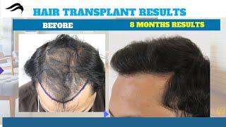 Hair Transplant In Dubai | Best Clinic Surgeon Cost & Center Of Hair Transplant In Dubai