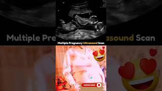 Multiple Pregnancy Ultrasound Scan  #pregnancy #fetus #ultrasound