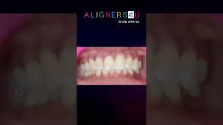 TEETH STRAIGHTENING WITH ALIGNERS4U #shorts #aligners #teeth #dental #invisalign #hyderabad #smile