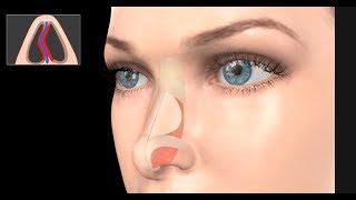 Deviated Septum Surgery (Septoplasty)