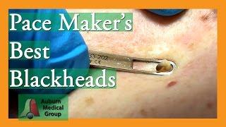 Best of Pace Maker's Blackheads Removed #popping | Auburn Medical Group