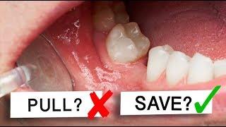 Can Loose Teeth Be Saved? To Pull or Not To Pull