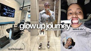 GLOW UP JOURNEY: Fixing My Teeth Part 1 (Invisalign + Porcelain Veneers)