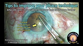 CataractCoach 1245: tips to improve your phaco technique