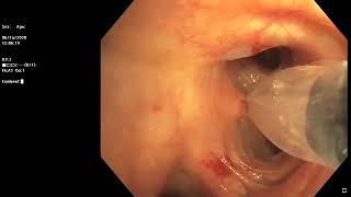 Chartis Assessment