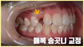 매복 송곳니 교정치료, 송곳니가 안 나요 / orthodontic treatment of impacted upper canine (maxillary canine exposure)