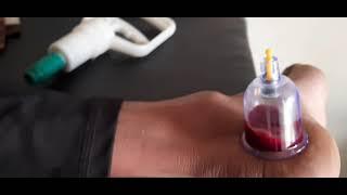 ankle wet cupping hijama therapy for pain relief