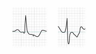 How to tell if a stress ECG (EKG) is positive?