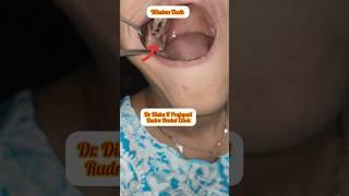 Akkal Dadh Kaise Nikalte Hai |Wisdom Teeth Removal #trending #shorts ##teeth #dr #youtubeshorts