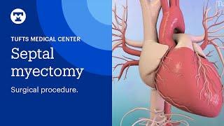 Septal Myectomy: Surgical Procedure for Hypertrophic Cardiomyopathy (HCM) |Tufts Medical Center