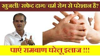 आप किसी भी तरह के चर्म रोग से पीड़ित है ?? पाएं रामबाण इलाज !! How to treat skin diseases naturally.