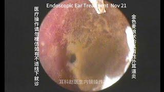 Ear wax removal, Golden earwax fungus dry sheet cleaning 20241121