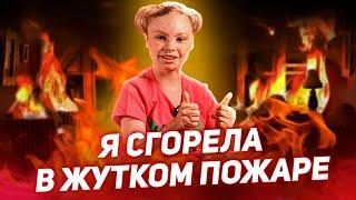 Я СГОРЕЛА В ЖУТКОМ ПОЖАРЕ / ИСТОРИЯ АЛЕСИ ПЕТРАКОВОЙ [Добрый Волшебник]