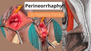 Perineorrhaphy | Step by Step Reconstruction of Perineal Body | Dr Deeksha Pandey