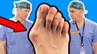 Bunions: Causes and Treatments