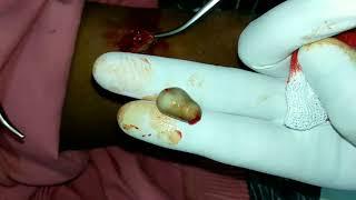 Removal of cyst live surgery