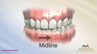 Orthodontic Treatment for Narrow Upper Jaw with Functional Shift - Expander or Spacer