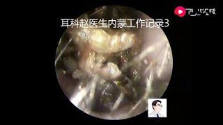 Portable otoendoscopy for cholesteatoma of external auditory canal for 10 minutes