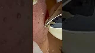 Skincare | Blackheads Removal #491 #tweezers skincare #blackheads blackheads