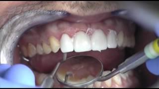 Prepless Veneers Procedure from Cosmetic Dental Associates in San Antonio, TX