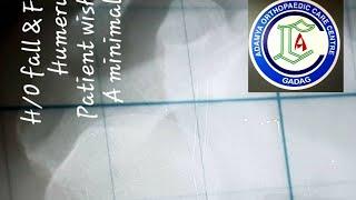 Humerus fracture | Retrograde nailing | Adamya Hospital Videos