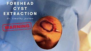 Cyst on Forehead Gets CANCELLED by Dr. Timothy Jochen! | CONTOUR DERMATOLOGY