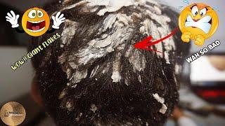 WOW!!! Giant Dandruff Removal - Scratching Dandruff (Giant Flakes) On Scalp#104