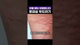 이럴 때는 응급실 가야 됩니다 #두드러기 #피부과교수