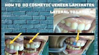 #Restorative#how to do cosmetic veneer of lateral to lateral upper incisors#cosmeticdentistry