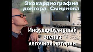 Инфундибулярный стеноз легочной артерии, чреспищеводная эхокардиография.