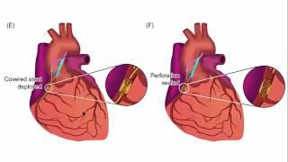 How to treat main vessel coronary perforation: step-by-step