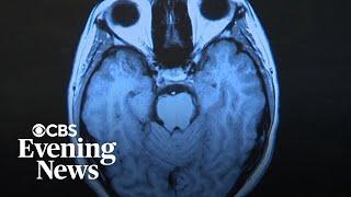 Researcher says Long COVID causing "great deal of suffering"