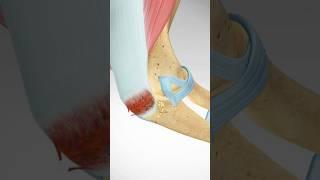 Triceps Tendon Avulsion and Surgical Repair #triceps #weightlifting