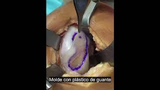 Cartilage Defect Treatment Using High-Density Autologous Chondrocyte Implantation (HD-ACI)