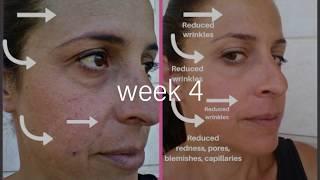 Project E Beauty LED Mask 30-Day Trial | LED Mask Before & After