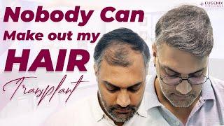 Best Hair Transplant in Ahmedabad | Best Results & Cost of Hair Transplant in Ahmedabad