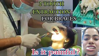 Tooth extraction for braces VLOG | how to brush and eat after extraction | is it painful ?