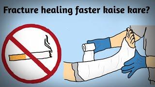 Fracture bone healing fast kaise kare? how can fracture healing happen faster?