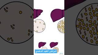 أمراض الكبد الدهني غير الكحولي