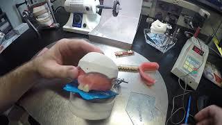 Denture Set Up Using The OMP