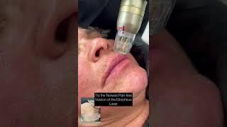 New treatment  This Hollywood secret helps celebrities like Kim Kardashian tighten skin 