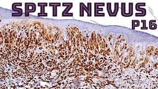 Spitz nevus with p16 immunohistochemistry (pathology dermpath dermatopathology immunostain)