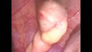 Two ports Laparoscopic Appendicectomy by Dr. Naser Abu Shaban FRCSI