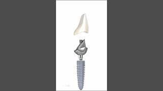 Ceramic Crown & Implant Abutment Anatomy