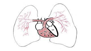 Right Heart Failure by Mark Andreae