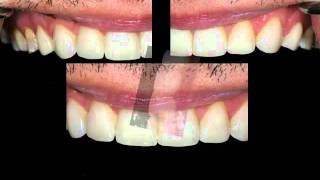 Chicago Evanston Porcelain Veneers