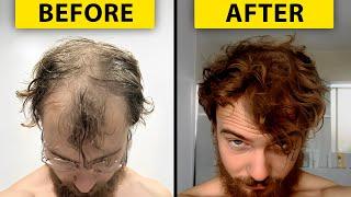 Preventing Balding: What I Did Before It Was Too Late... | Hair Surgeon Reacts