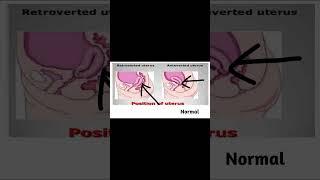 retroverted uterus and infertility #shorts #ytshorts