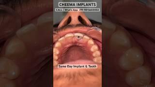 Upper front Tooth extraction implant procedure surgery accident broken incisors Jalandhar Straumann￼